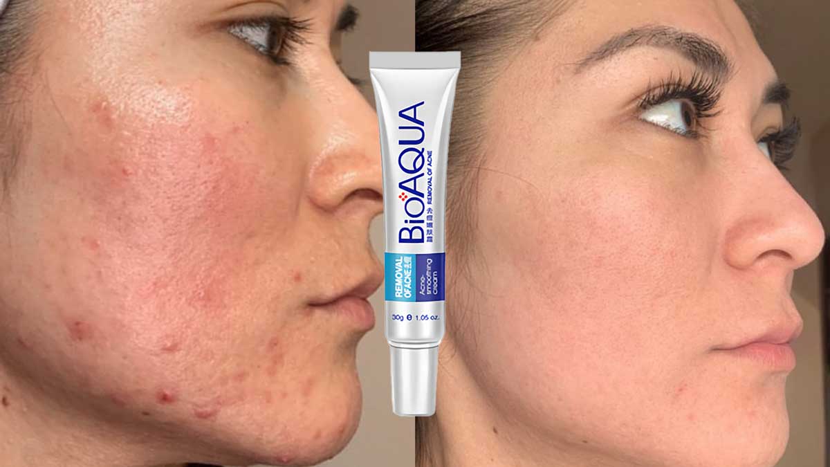 نتیجه استفاده از کرم ضد جوش بیوآکوا اصل 