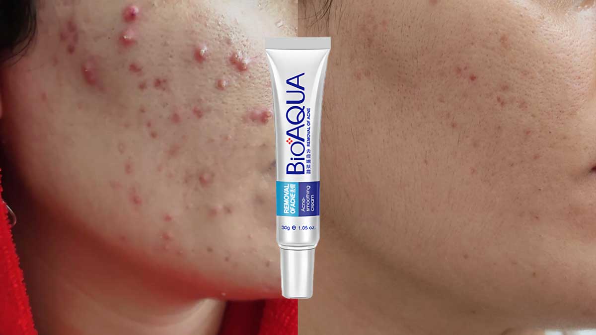 نتیجه استفاده از کرم ضد جوش بیوآکوا اصل 